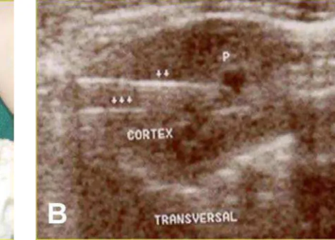Figura 3 – Agulhas do termômetro nas camadas cortical e medular orientado por ultra- ultra-som