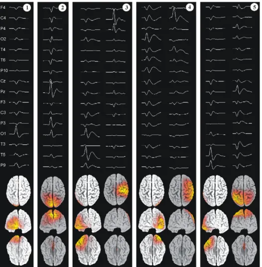 Fig. 1. Topographies of interictal spikes for the ﬁve patients. (Above) Sub-sample of the averaged spikes, demonstrating multifocal activity for patients 3, 4 and 5, with a combination of rolandic and posterior spikes