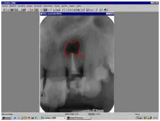 FIGURA 12 - Imagem radiográfica mostrando a área total da lesão periapical  fornecida pelo programa VixWin 2000 após a escolha da opção 