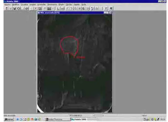 FIGURA 14 - Imagem radiográfica mostrando a delimitação da área, em mm 2  , de  neoformação óssea detectada pela subtração digital