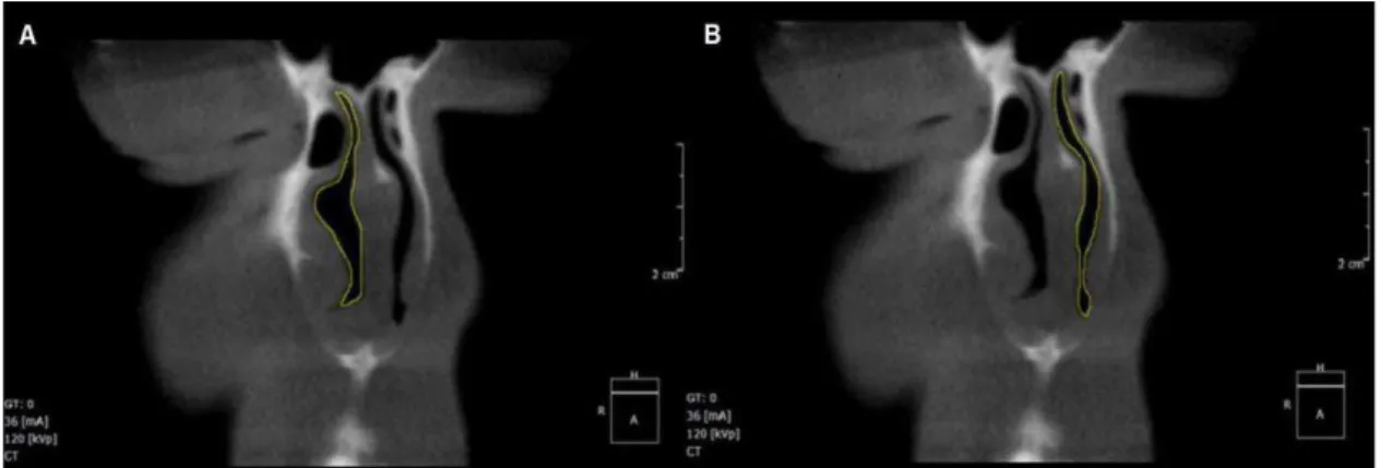 Figura  3  –  Cortes coronais (A e B) mostrando respectivamente a delimitação inicial da  cavidade nasal direita e esquerda