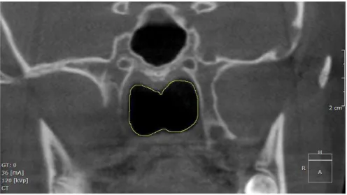 Figura 4  –  Corte coronal mostrando a delimitação final da cavidade nasal. 