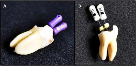 Figura  3  - ! A)  Odontometria  e  confirmação  visual  de  forames  separados;  B)  Confirmação do diâmetro anatômico no comprimento de trabalho (CT)