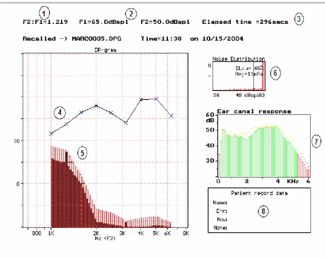 Figura 1: Registro de emissões otoacústicas-produto de distorção presentes –  análise gráfica (registro obtido no equipamento ILO292 – Otodynamic)