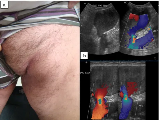 Figura 2 – Imagens operatórias: a) imagem do aneurisma a emergir da  croça da veia grande safena, a confluência safenofemoral e a primeira  colateral da croça, b) colocação eletiva de pinças hemostáticas na  confluência safenofemoral e na primeira veia col