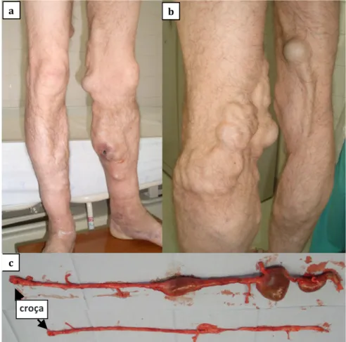 Figura 3 – Úlcera traumática no membro inferior  esquerdo com exuberante insuficiência venosa  bilateral.a) vista anterior; b) vista posterior e   c) peça cirúrgica onde se pode observar: veia  grande safena esquerda com um aneurisma  fusiforme e dois sacu