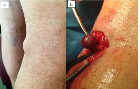 Figura  4 – Imagem da fossa popliteia  com massa aneurismática: a) vista de  perfil; b) intra-operatória do aneurisma  da pequena safena.