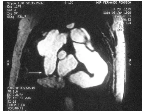 Fig. 2  A type A dissection with a filling defect close to the aortic root (arrow) due to absence of contrast entry into this area.