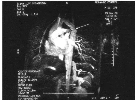 Fig. 8  A coarctation operated on twenty-two years prior to this exam showing remnant collaterals and mild recoarctation