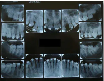 Figura 24-  Radiografias periapicais mostrando que o dente 13 está irrompendo e o 23 está bem posicionado