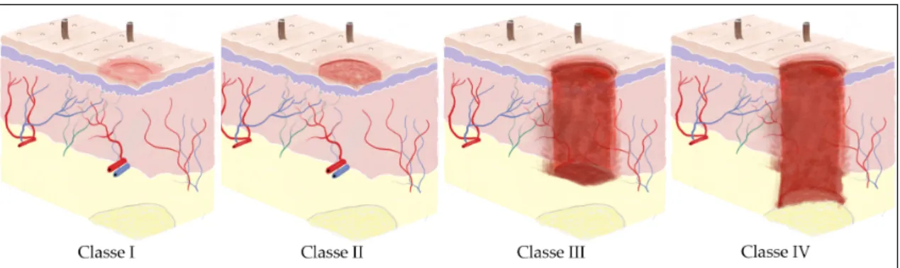 Figura 2.2: Ilustrações tridimensionais do sistema de classes do EPUAP para úlceras de pressão
