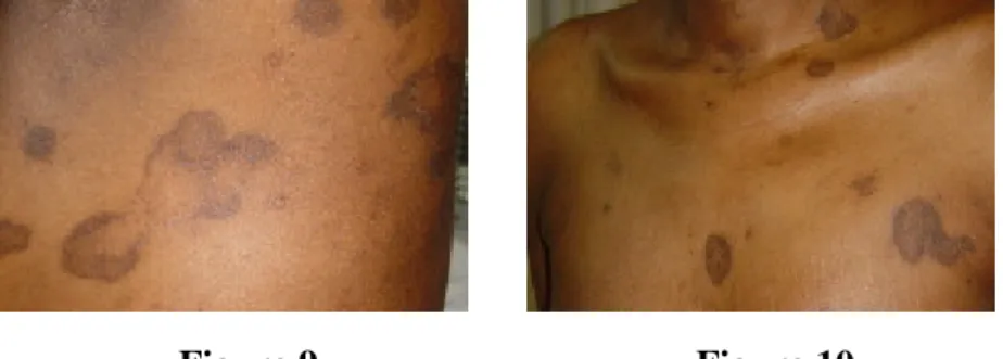 Figure 9. Successful therapy of the intestinal disease with  prednisolone and mesalazine and simultaneous improvement  of the skin disease 
