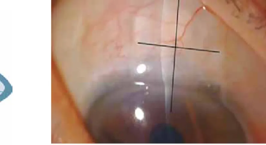 Fig. 2: Anterior segment optical coherence tomography scans  were done through sagittal and transversal plans to the implant  (as shown by lines)