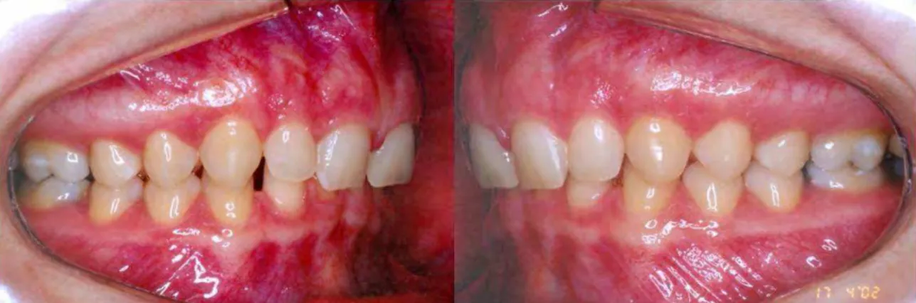 Foto 1 - Relação molar Classe II de Angle bilateral. 