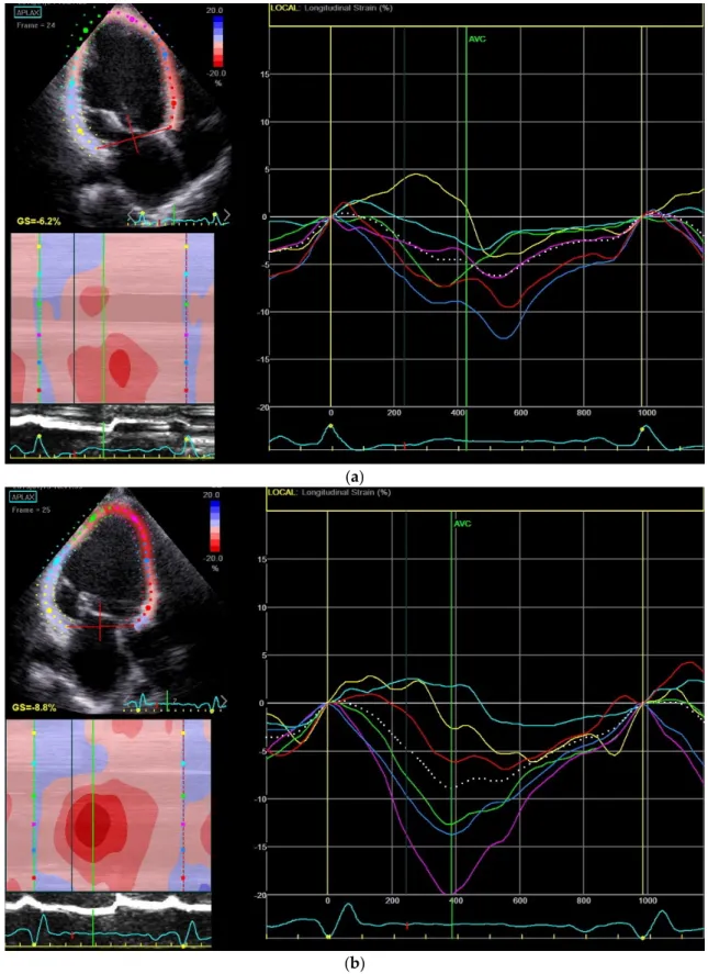 Figure 1. Mechanical dispersion index reduction before (a) and after (b) six months of Sacubitril- Sacubitril-Valsartan ( LCZ696) therapy in a patient with an ischemic cardiomyopathy in the APLAX view