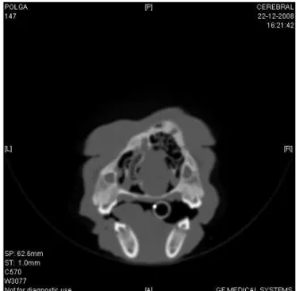 Figura  4  –  Imagem transversal de TC ao nível da  porção  rostral  da  cavidade  nasal  com  a  presença  de  uma  massa  no  lado  direito  (janela  óssea  da  Fig
