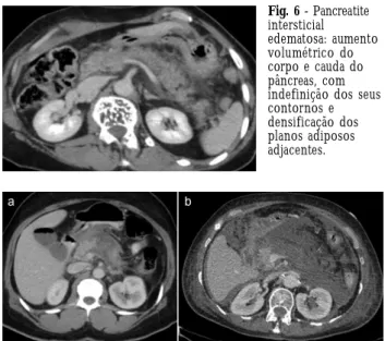 Fig.  5  -  Evolução  da  pancreatite  aguda  necrotizante  -  a)  fase  inicial,  na data  de  admissão  hospitalar:  aumento  volumétrico  do  pâncreas  com realce heterogéneo  do parênquima; b) fase  tardia, 13 dias após  a admissão hospitalar:  colecçã