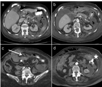 Fig.  16  -  Doente  com  pancreatite  aguda  necrotizante  infectada  e  fistula cólica  (imagem  a;  mesmo  doente  que  Fig.12)  submetida  a   mini-marsupialização  com  necrosectomia  pancreática  e  colocação  de  dreno aspirativo