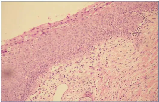 Figura 3. Fotomicrografia de corte histológico do colo do útero representando  de LIEAG