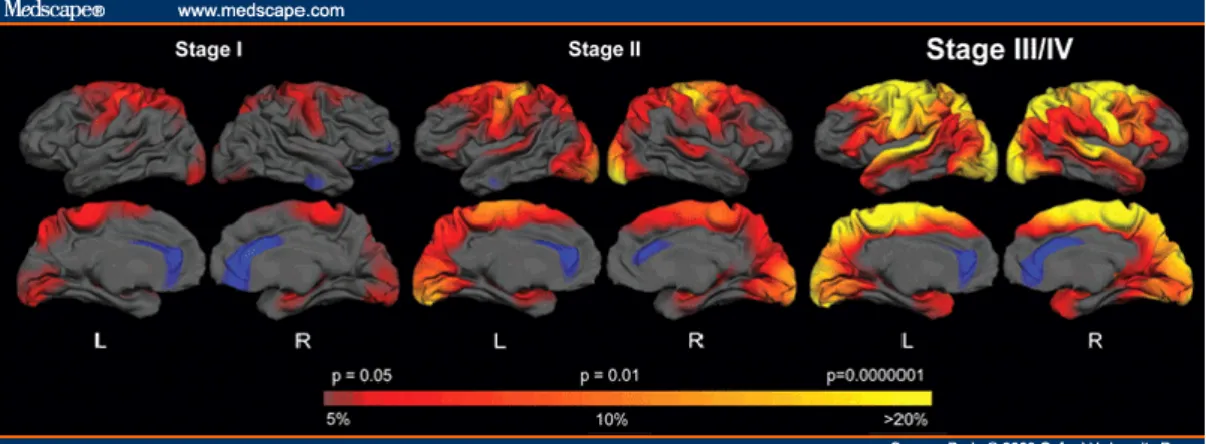 Figure 1.2. Model of disease progression. Selective dysfunction and death of striatal neurons and to  lesser  extent  neurons  within  cerebral  cortex