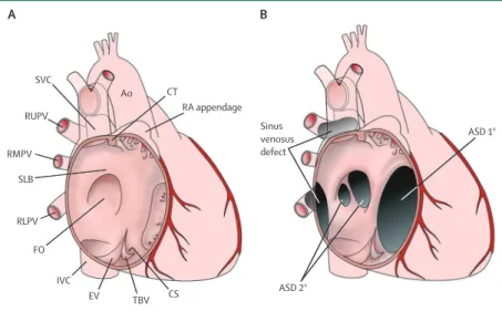 Figure 2: Anatomy of the atrial septum and neighbouring structures