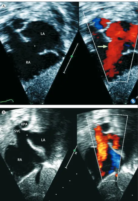 Figure 4: Echocardiographic imaging of atrial defects