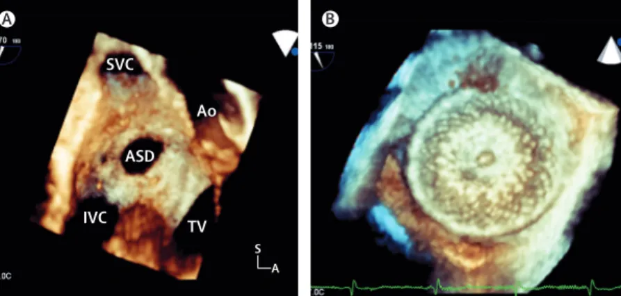 Figure 5: Three-dimensional imaging of a secundum atrial septal defect imaged by a transoesophageal  echocardiogram before (A) and after (B) device closure