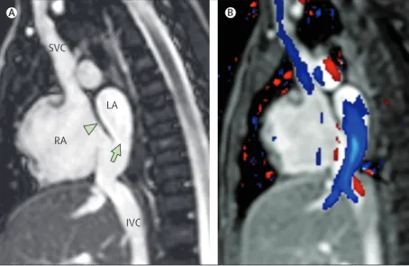 Figure 6: Inferior sinus venosus defect imaged by cardiac MRI