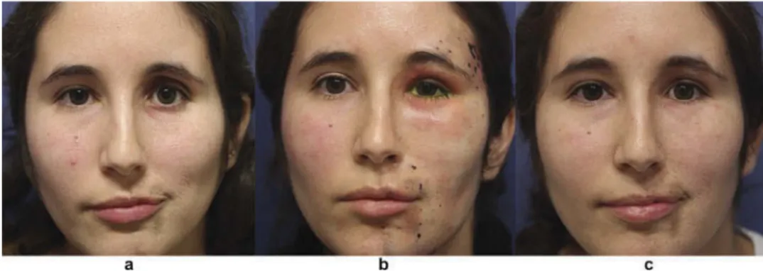 Figure 1. Parry Romberg Syndrome.