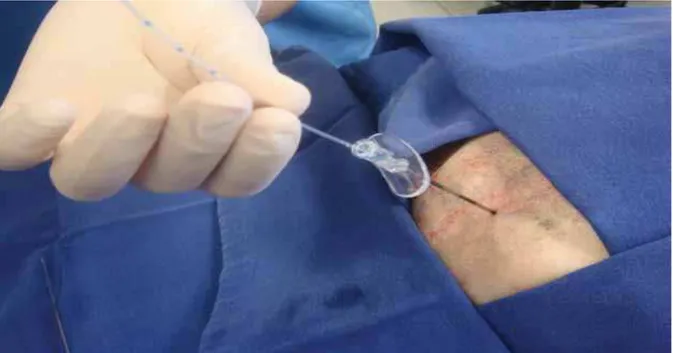 Figura 4. Introdução do cateter epidural através da agulha de Weiss. Foto: Arquivo  pessoal 