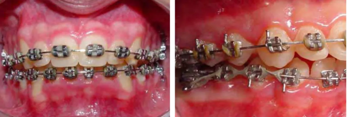 FIGURA 1 – Aparelho ortodôntico fixo com bandas instaladas nos  primeiros molares permanentes e braquetes colados em  pré-molares e dentes anteriores