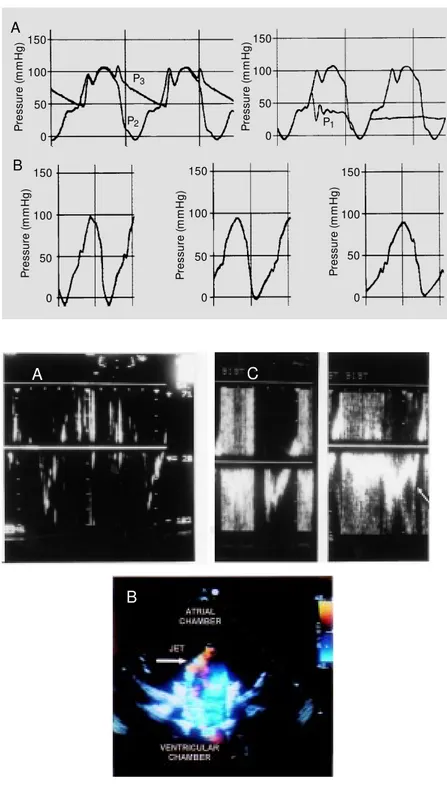 Figure 2 - Panel A, Pressure curves w ere recorded in the “ atrial”  (P 1 ) and “ ventricular”  (P 2 ) chambers and also at the “ peripheral circulation”  (P 3 ) level of the flow model