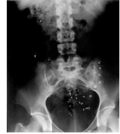 Figure 3 - Hindgut dysfunction in a patient w ith idiopathic constipation (IC). An abdominal X-ray taken on day 7 show s stasis of radiopaque markers in the left colon.