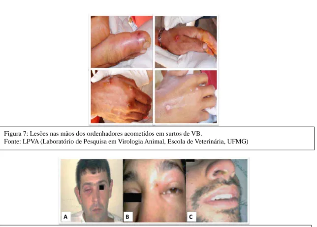 Figura 9: Lesões ulcerativas em tetos de vaca leiteira (A) e mucosa oral de bezerro (B) em uma propriedade  com caso de VB