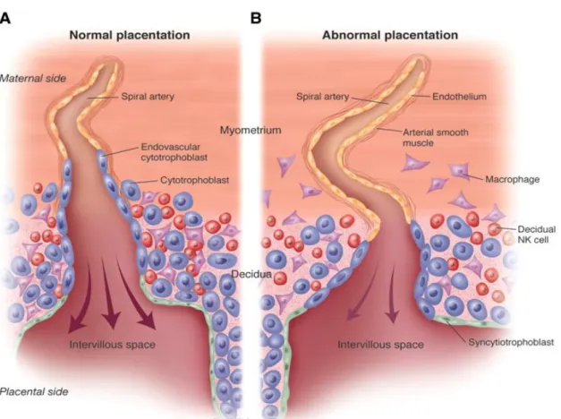 Figura  1  -  Alterações  placentares  e  Pré-eclâmpsia.  Placentação  Normal  (A)  e  Placentação  Anormal  (B)  entre  as  15-16  semanas  de  gravidez
