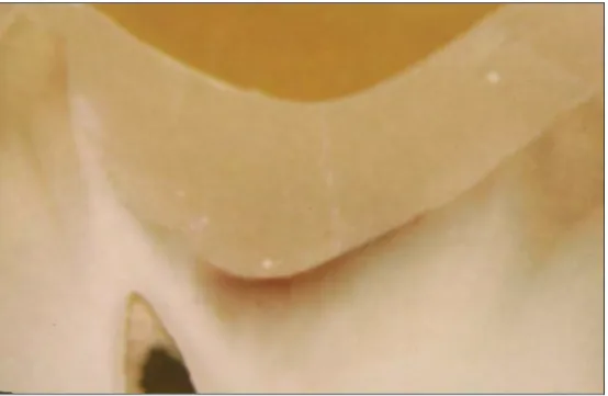 FIGURA 3 -   Grupo GI.1: Interface entre o ionômero de vidro KETAC FILL e a  dentina, após remoção de tecido cariado pela técnica convencional –  Macroscopia 60X 