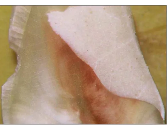 FIGURA 6 -   Grupo GI 2: Interface entre o material restaurador ionomérico  VIDRION R e a dentina, após remoção de tecido cariado pela técnica  convencional – Macroscopia – 60 X