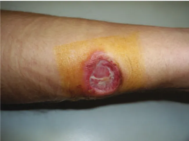 Fig. 1. Asymptomatic, oval-shaped, 5-cm exsudative deep ulcer on the forearm, with undermined infiltrated borders.