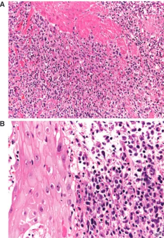 Fig. 4. Dense infiltrates of atypical lymphocytes within the entire dermis. Please note pseudoepitheliomatous epidermal hyperplasia and papillary dermal edema.