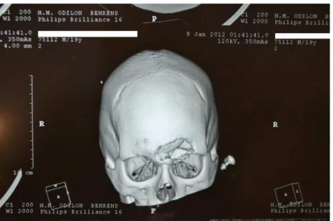 FIGURA 7  – Reconstrução 3D onde observa-se afundamento do osso frontal. 