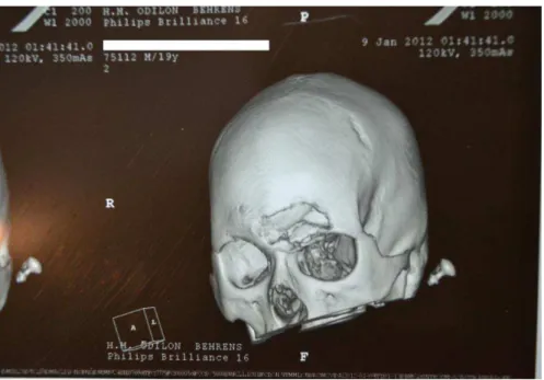 FIGURA 8  – Reconstrução 3D com comprometimento do teto supraorbital e afundamento do  osso frontal