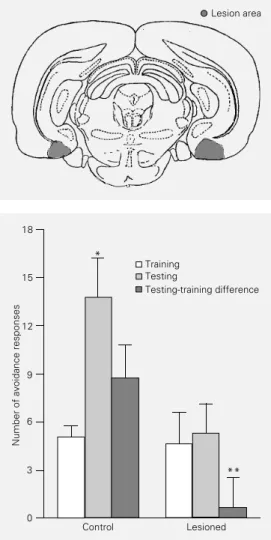 Figure 1 - Drawing of a repre- repre-sentative coronal section  show-ing the localization of the lesion (shaded area).