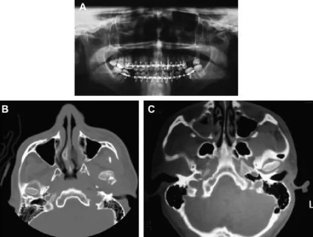 FIGURA 6- A- Radiografia panorâmica demonstrando deslocamento anterior do côndilo  esquerdo