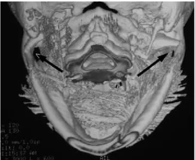 FIGURA 7 - Tomografia computadorizada mostrando  fratura bilateral de côndilo mandibular