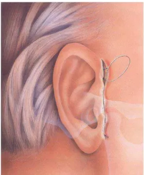FIGURA 13- Sutura do acesso pré-auricular. (  Fonte: Acessos cirúrgicos de Ellis, 2000)