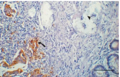 Figure 1 - Immunoperoxidase staining of a colorectal carcinoma tissue section w ith mAb 6D1.1