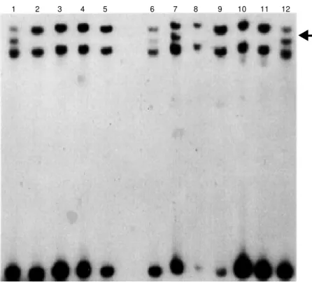 Figure 1. PCR-SSCP of p53 exon 6 in cervical carcinoma. Four samples present band shifts compatible w ith sequence alterations, as indicated by the arrow .