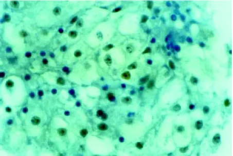 Figure 1. p53 Immunoreactivity (brow n nuclei) in adenomatous tissue from one of the cases.