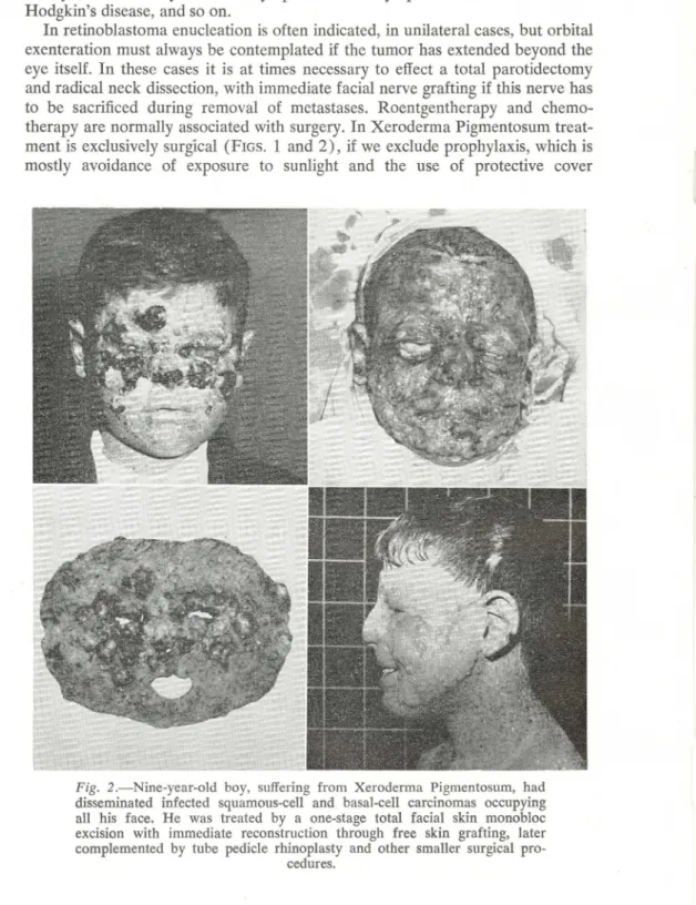 Fig. 2.-Nine-year-old boy, suffering from Xeroderma Pigmentosum, had disseminated infected squamous-celI and basal-celI carcinomas occupying alI his face