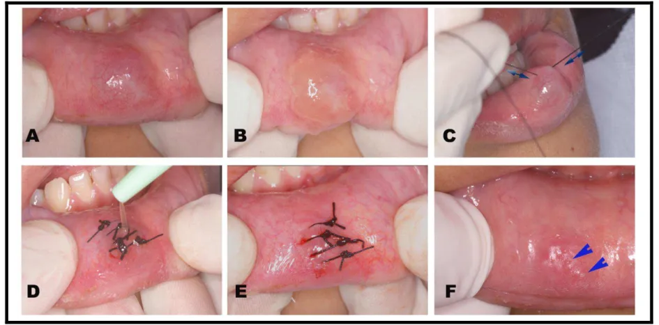 Figure  1  -  Patient  #14.  Clinical  aspect  of  selected  mucocele  and  upgraded  micro-marsupialization  technique,  step  by  step